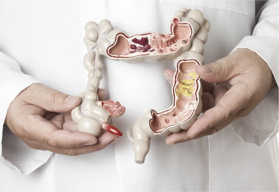 Câncer Colorretal: Sintomas, Rastreamento e Diagnóstico